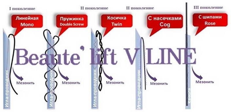 Нити для подтяжки лица